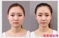 4个方法重塑脸部轮廓 轻松瘦小脸